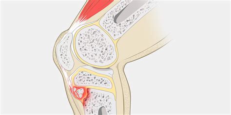 Osgood Schlatter Disease — The Complete Injury Guide Vive Health