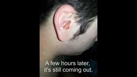 Worst Ear Infection Ever Must See Youtube