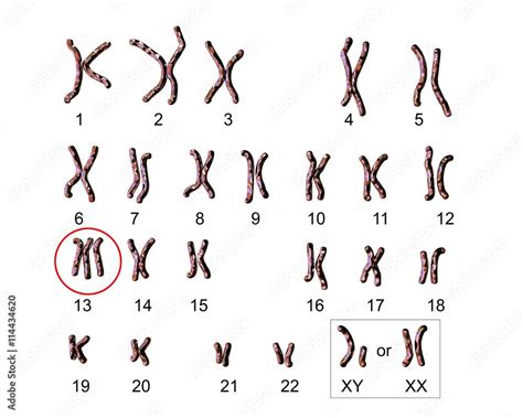 Patau Syndrome Karyotype Labeled Trisomy 13 3d Illustration