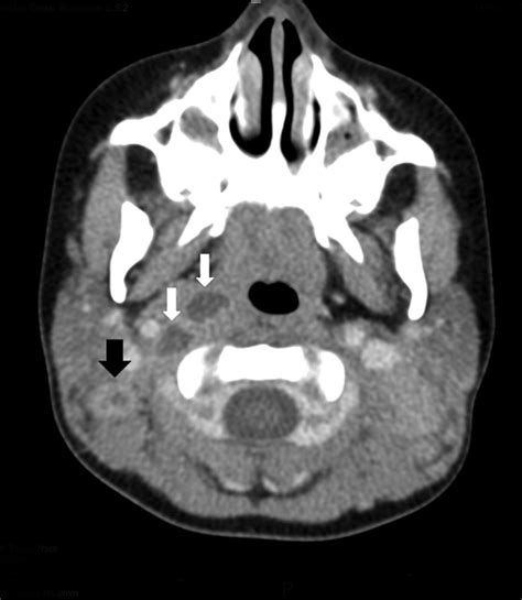 Figure Acute Cervical Lymphadenitis Caused By Mycobacterium