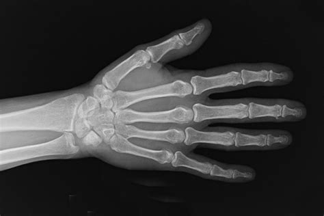 Radiology Studies X Ray Hand Surgery Source