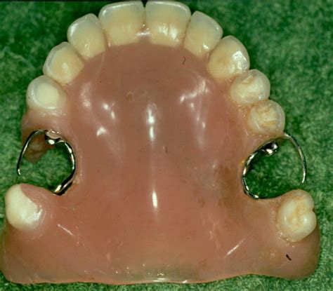 Types Of Dentures And Their Costs Dental Solutions