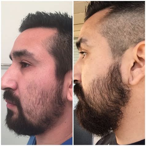 Patchy Beards Before And After Beard Style Corner