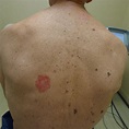 Skin Cancer, Symptoms, Pictures, Photos, Types, Signs, Melanoma