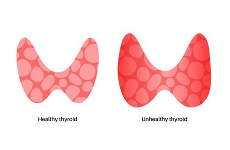 Hypothyroidism Illustrations Royalty Free Vector Graphics And Clip Art