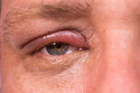 Chalazion Bump On Eyelid Causes And Treatment The Eye News