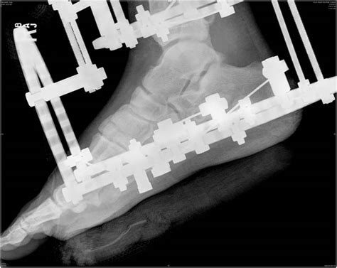 Calcaneal Intraosseous Lipoma Treated With External Fixation A Case