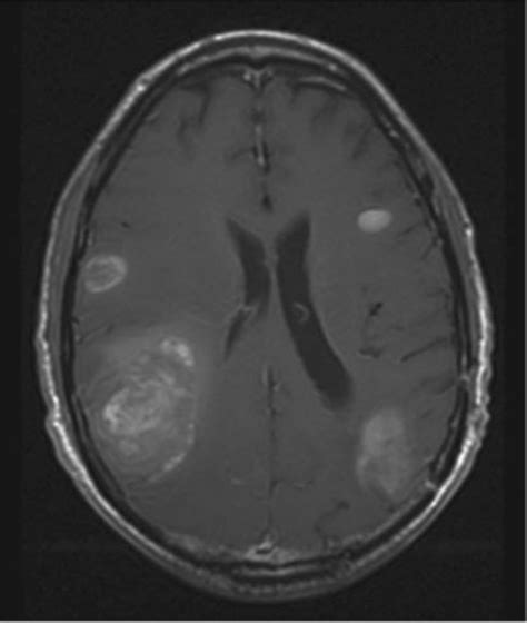 Brain Metastases Rcp Journals