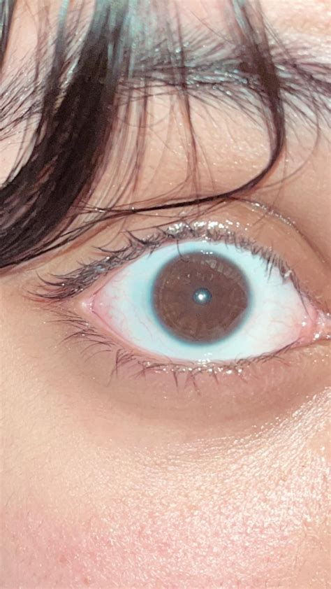 im not sure what this blue ring around my iris is but i ve had it since birth and a few people