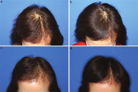 The Latest Advance In Hair Regeneration Therapy Using Proteins Secreted