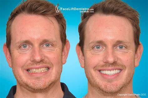 How To Improve Your Jawline Surgery Or Nonsurgical Methods Justinboey