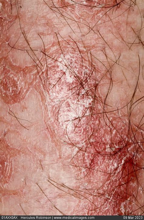Stock Image Dermatology Psoriasis Multiple Pink Patches With White