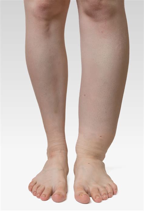 Top 20 Swelling In Legs Home Remedies
