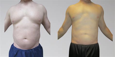 Men Before And After Stomach Liposuction Sono Bello