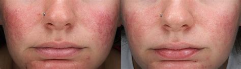 Intense Pulse Light Before And After Before And After