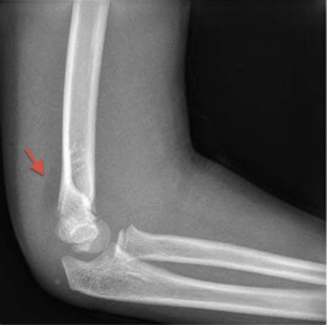 Pediatric Supracondylar Humerus Fractures Journal Of Hand Surgery