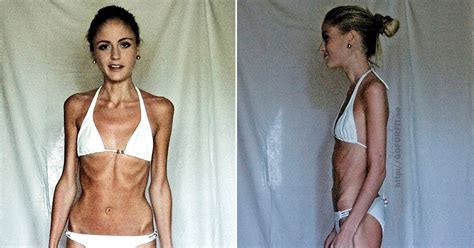 Anorexic Woman At Risk Of Dying After Dropping To 5st Looks Incredible