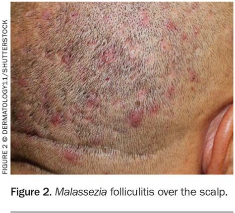 Folliculitis Scalp