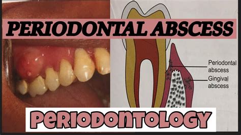 Periodontal Abscess Ii Periodontology Dental Clinic