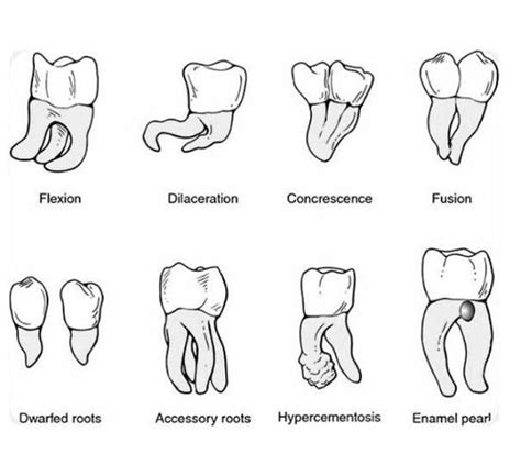 Root Characteristicsanomalies Dental Hygiene Education Dental