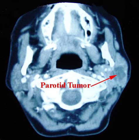 Parotidectomy Facial Nerve Dissection And Sialoceles