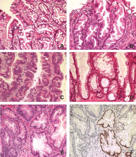 Examples Of Serrated Polyp Subtypes A Goblet Cell Type Hyperplastic