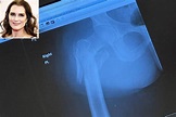 Brooke Shields Shares X-Ray of Her Broken Femur