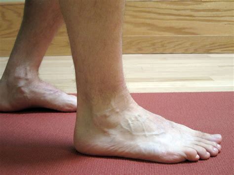 How To Care For Foot And Ankle Sprains Foot And Ankle Vrogue Co
