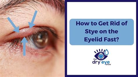 How to not get eyeliner on eyelids. Pin by LSchwanke77 on Personal Care in 2020 | Eye stye remedies, Eye treatment, Pimple on eyelid