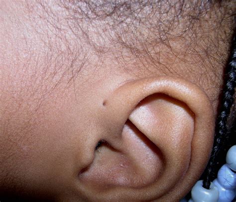 Preauricular Pits A Hole In Your Childs Ear