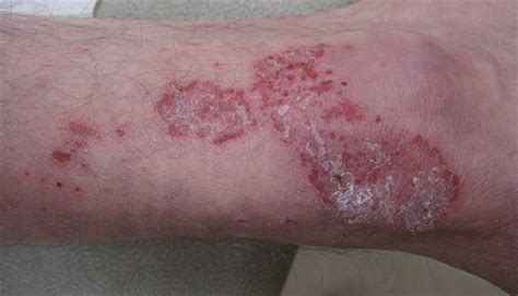 Itchy Burning Rash That Recurs On The Legs Every Winter Clinical Advisor