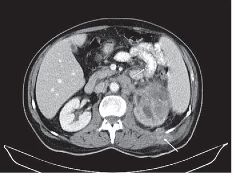 Figure 1 From Incidental Diagnosis Of Transitional Cell Carcinoma