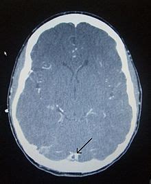 Common subtypes include transverse sinus thrombosis and superior sagittal sinus. CT venogram showing a filling defect in the sagittal sinus ...