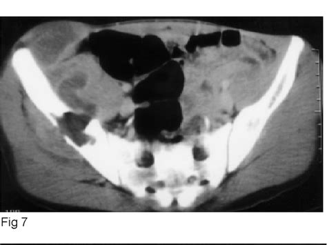 Figure 1 From A Case Report Iliac Bone Tuberculosis With Iliopsoas