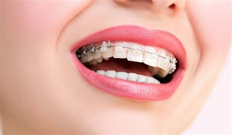 The Advantages Of Clear Braces Lach Orthodontic Specialists