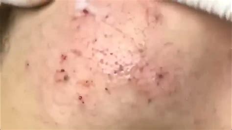 Extreme Case Of Ear Blackheads 2022 Professional Extraction Full Video