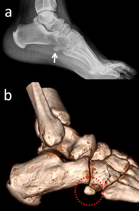 Cureus Accessory Ossicles Of The Foot And Ankle Disorders And A