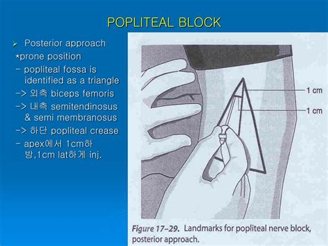 Popliteal Peripheral Nerve Block