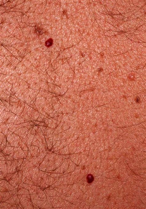 They are more common after a hormone burst such as puperty or pregnancy but also i cherry hemangioma: Cherry angioma (Cherry hemangioma, Senile Angioma ...