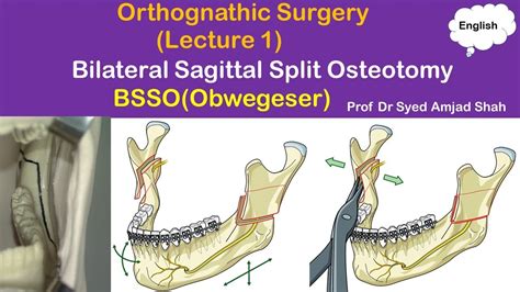 Obwegeser Bsso Bilateral Sagittal Split Osteotomy Orthognathic