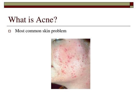 Ppt Acne Treatment Powerpoint Presentation Free Download Id700398