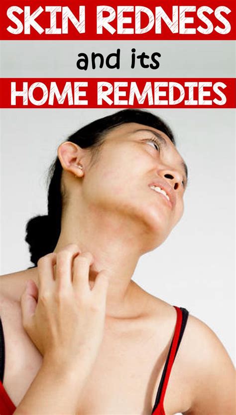 Skin Redness And Its Home Remedies In 2020 Skin Redness Redness