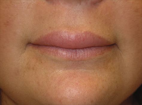 Asymptomatic Edematous Upper Lip In A 39 Year Old Woman—quiz Case