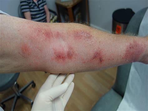 An Extremely Itchy Rash On The Arms Following Yardwork Clinical Advisor