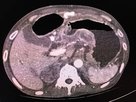 Adrenals Radiology Semester Cases