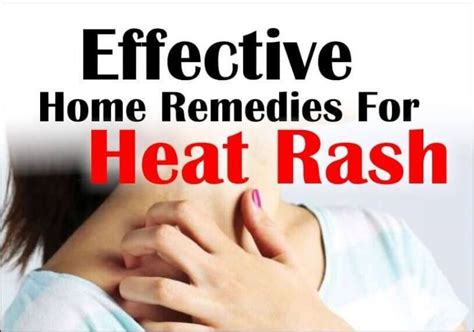 Heat Rash Treatment Causes And How To Prevent Health Blog