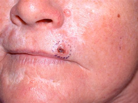 Superficial Basal Cell Carcinomas Pictures Photos