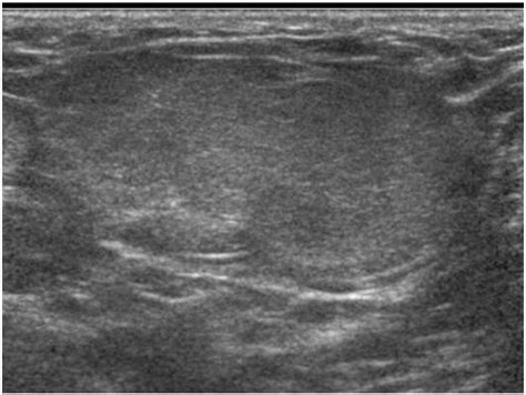 Sonographic Evaluation Of Inguinal Lesions Clinical Imaging