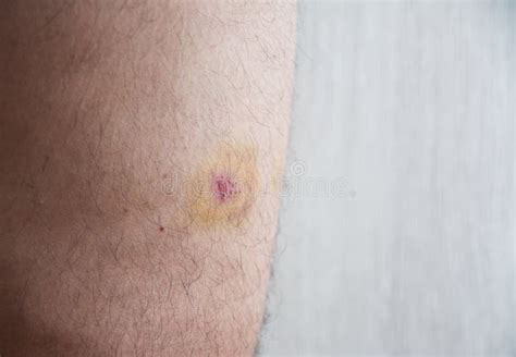 Bruise Hematoma On Leg Stock Photo Image Of Healthcare 250450420