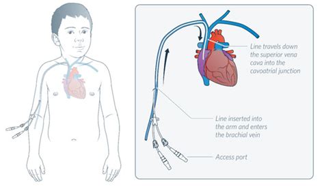 Kids Health Information Cvad Peripherally Inserted Central Catheter Picc